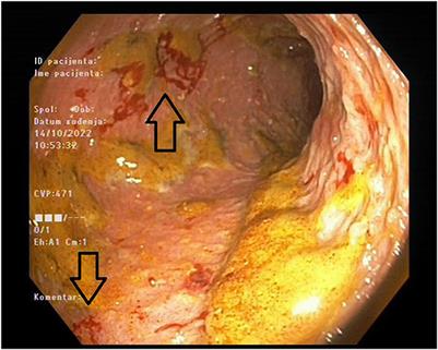 Case report: Sevelamer-associated colitis—a cause of pseudotumor formation with colon perforation and life-threatening bleeding